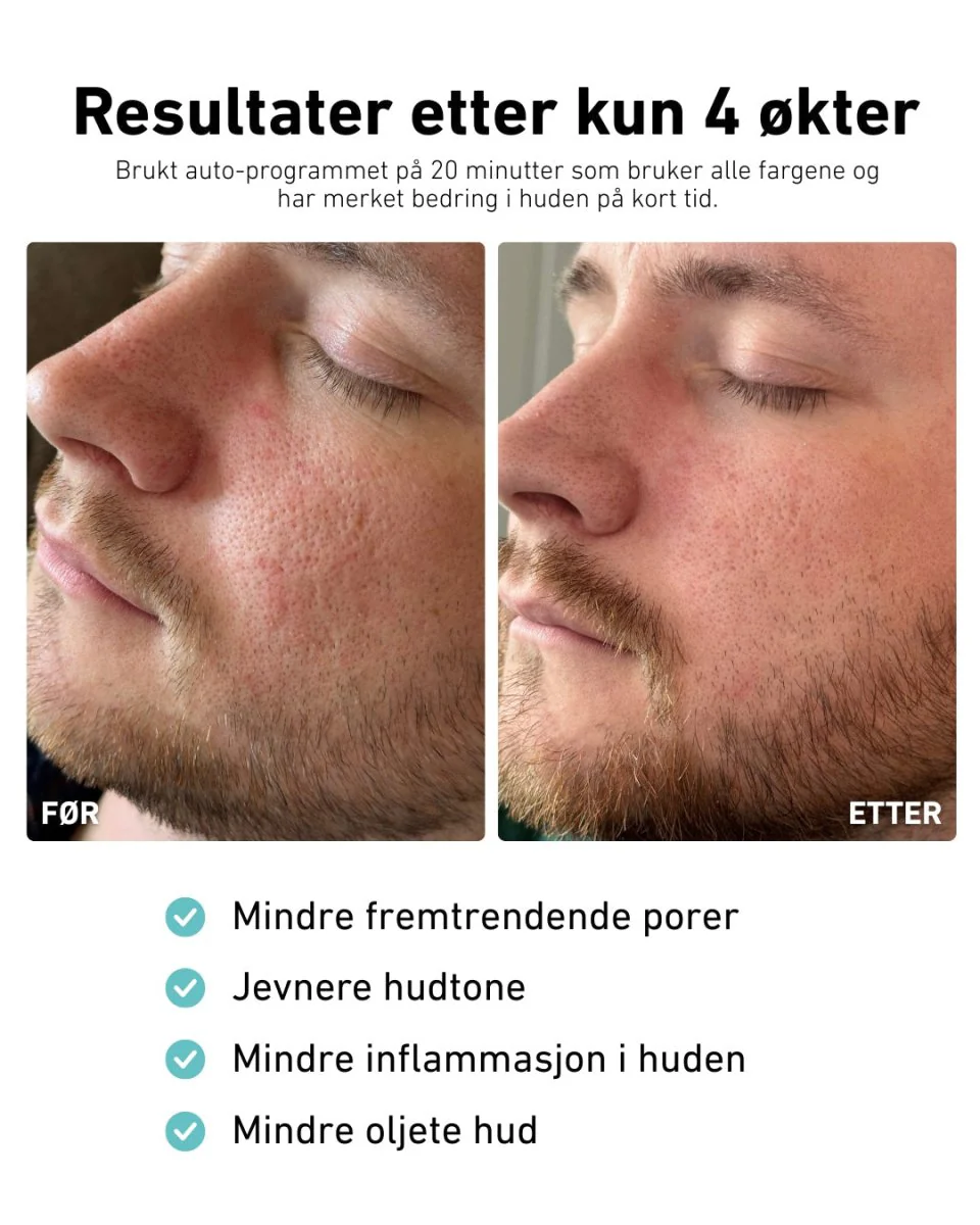 LED-lysmaske til ansikt mot akne, rynker og pigmentflekker - Image 4
