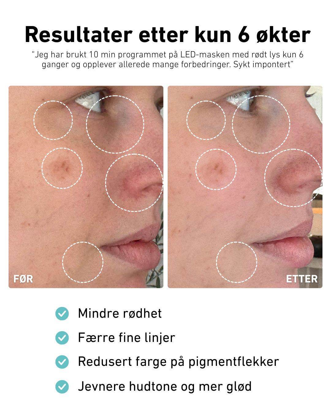 LED-lysmaske til ansikt mot akne, rynker og pigmentflekker - Image 5
